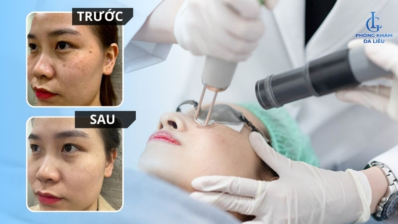 cách điều trị nám chân sâu