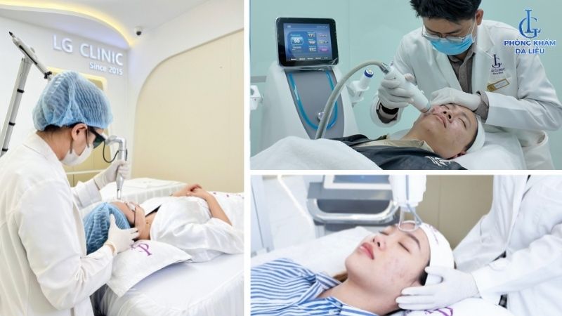 cách điều trị sẹo rỗ và sẹo lõm