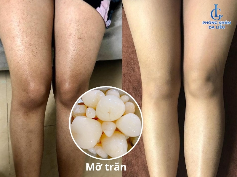 cách dùng mỡ trăn trị viêm nang lông