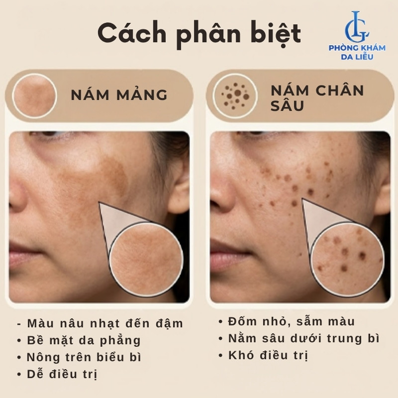 cách phân biệt nám mảng và nám chân sâu