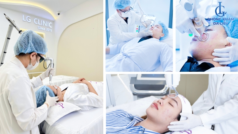 Điều trị sẹo rỗ đáy tròn