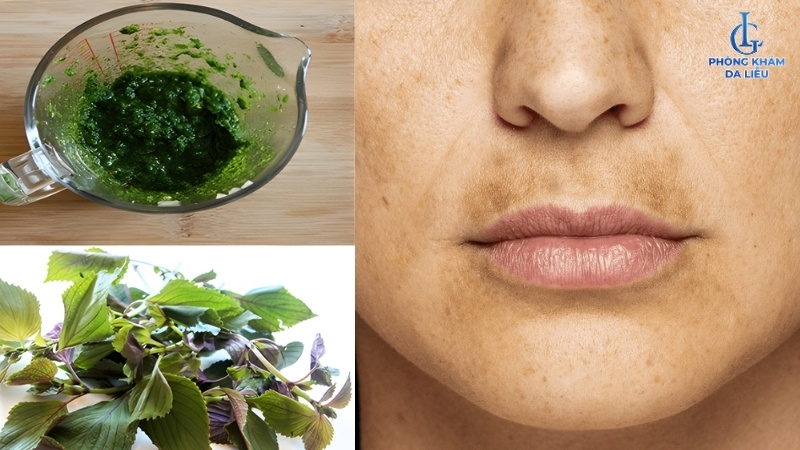 cách trị nám râu bằng lá tía tô