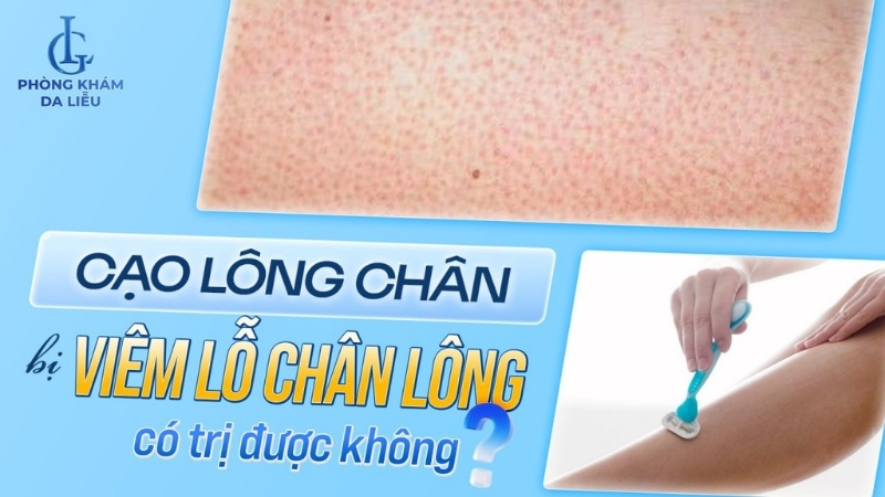 cạo lông chân bị viêm lỗ chân lông có trị được không