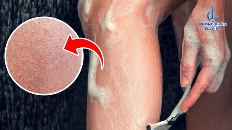 cạo lông chân bị viêm lỗ chân lông