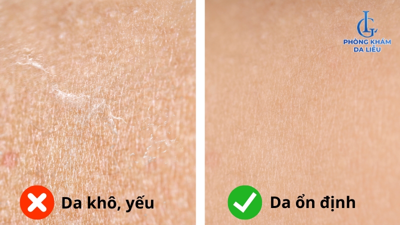 cạo lông chân gây viêm lỗ chân lông