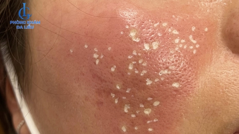 chấm tca trị sẹo đáy vuông