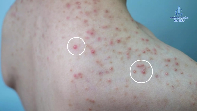 chống chỉ định trị viêm nang lông bằng dầu dừa