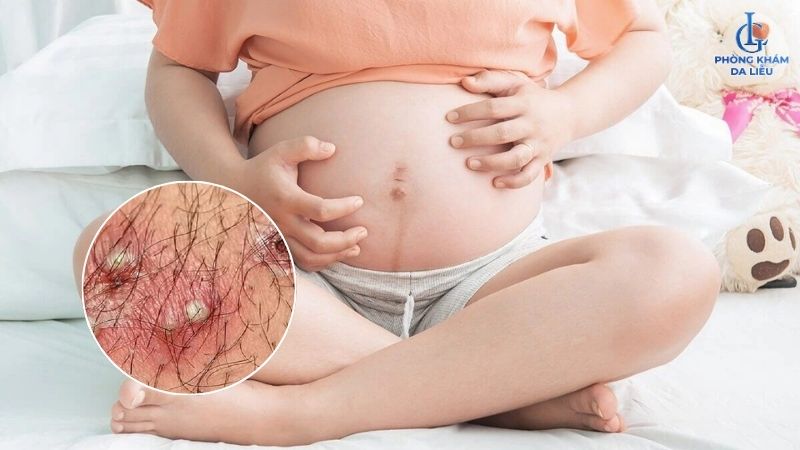 dấu hiệu nhận biết bà bầu bị viêm nang lông vùng kín