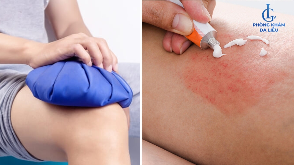 điều trị Viêm nang lông hồng ban hình mạng lưới