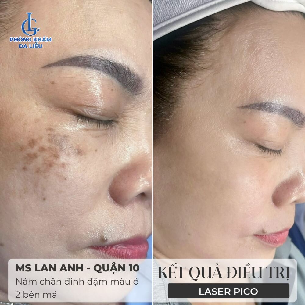 trị nám cánh bướm