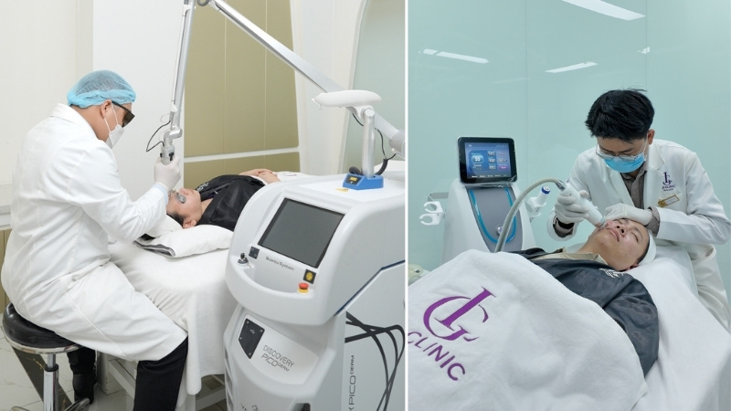 điều trị nám da mặt vùng má