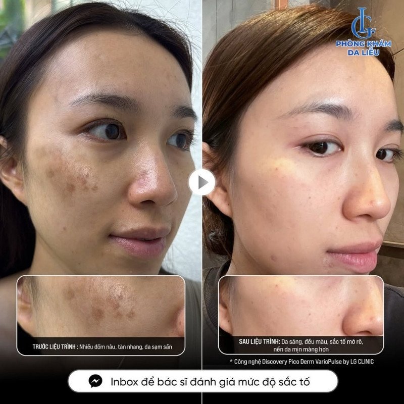 điều trị nám da