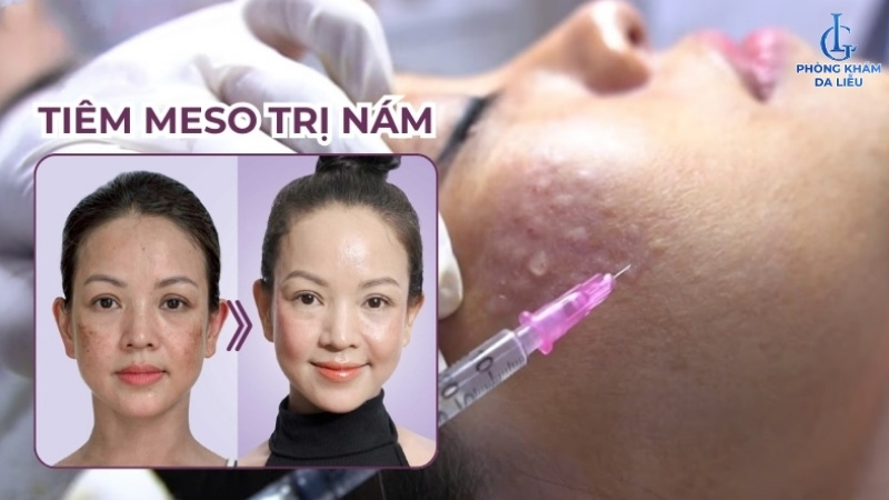 điều trị nám ở da