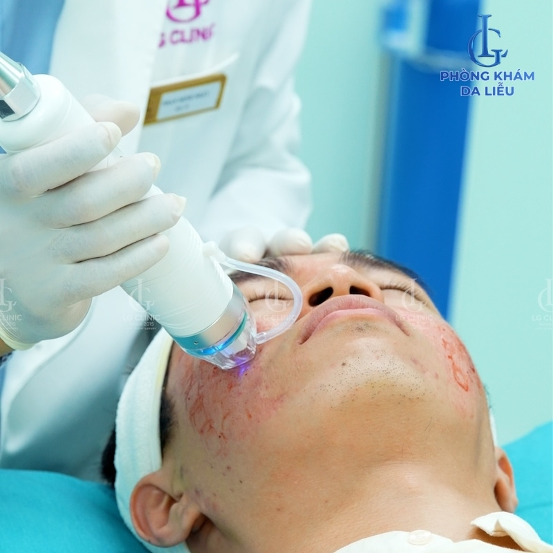 điều trị sẹo rỗ đáy vuông bằng công nghệ RF