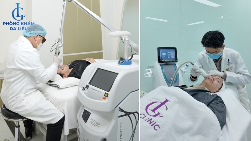 điều trị sẹo rỗ đáy nhọn hiệu quả