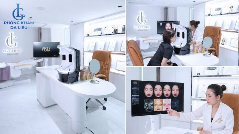 điều trị sẹo rỗ đáy tròn tại phòng khám da liễu lg