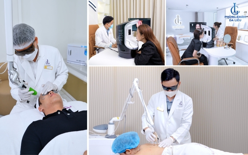 điều trị sẹo rỗ đáy vuông triple treatment