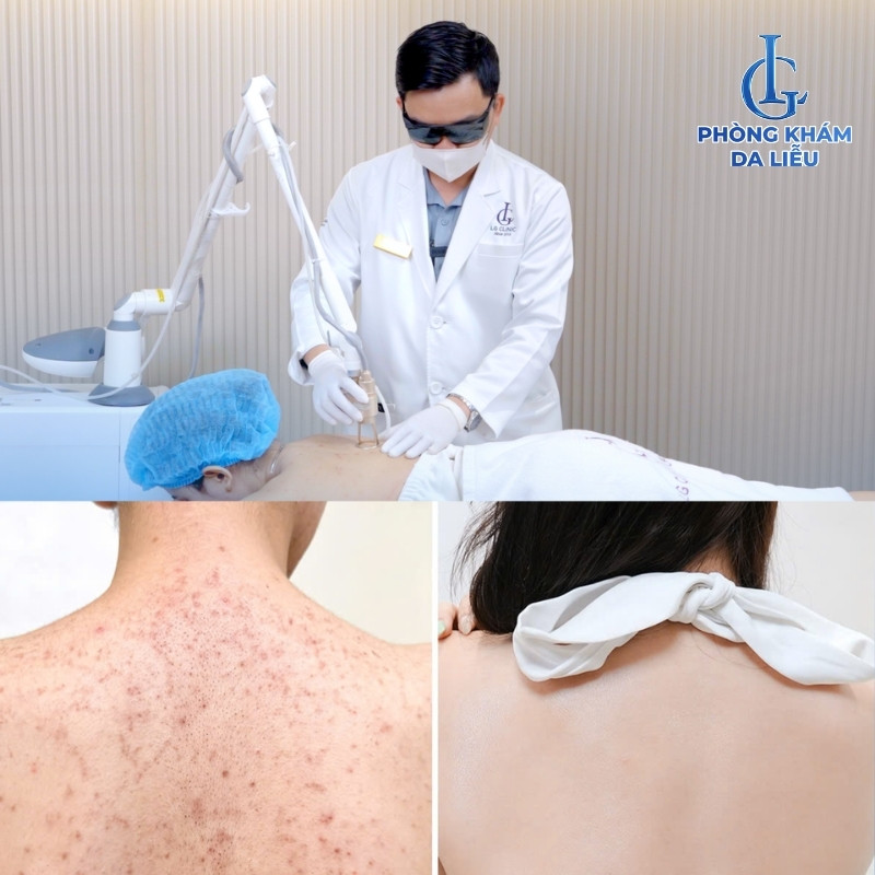 điều trị viêm nang lông