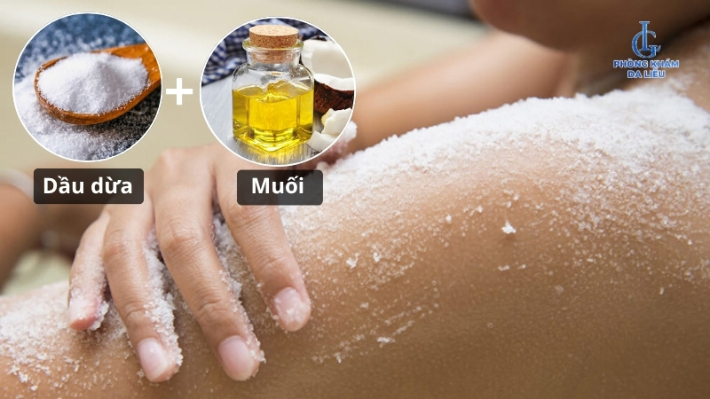 điều trị viêm nang lông bằng dầu dừa và muối