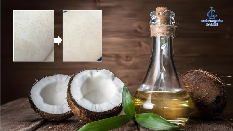 điều trị viêm nang lông bằng dầu dừa