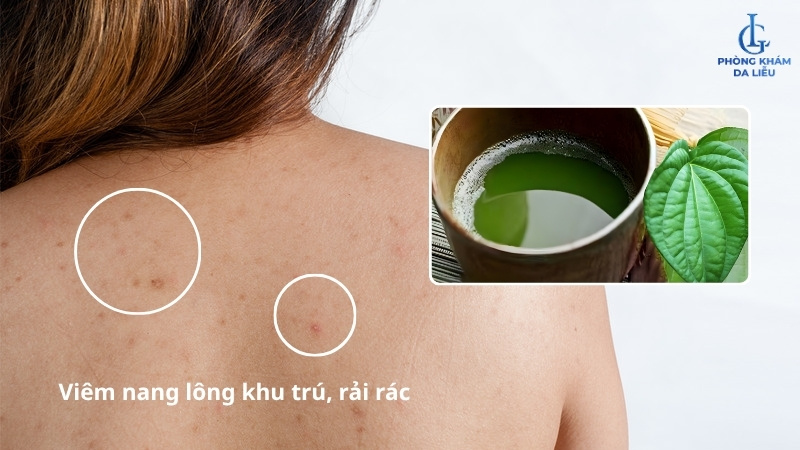 điều trị viêm nang lông bằng lá trầu không tại nhà