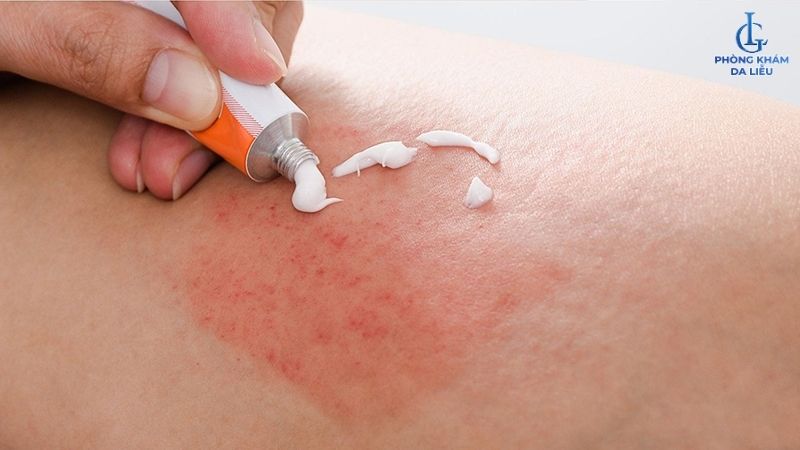 điều trị viêm nang lông vùng kín cho bà bầu