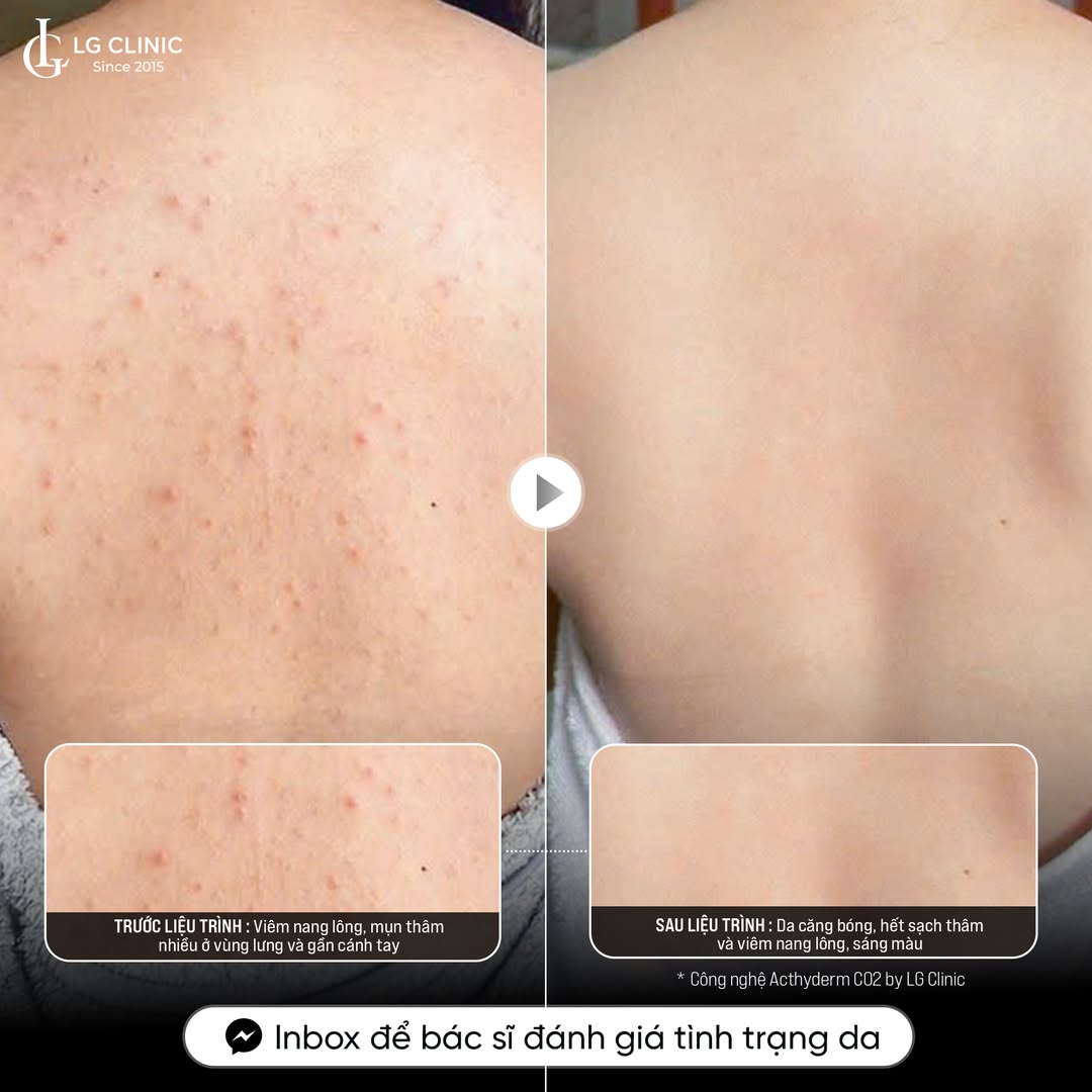 điều trị viêm nang lông