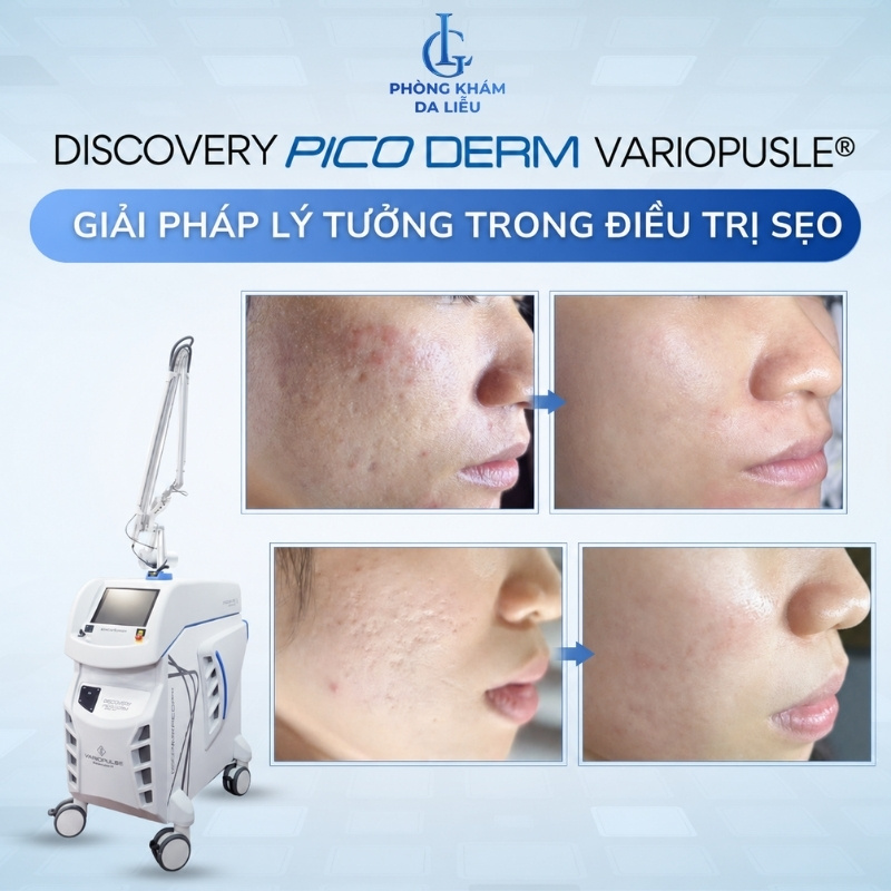 discovery pico derm variopulse trị sẹo đáy tròn