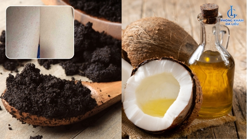 dùng bã cà phê và dầu dừa trị viêm nang lổ chân lông