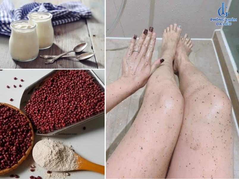 dùng bột đậu đỏ trị viêm nang lông