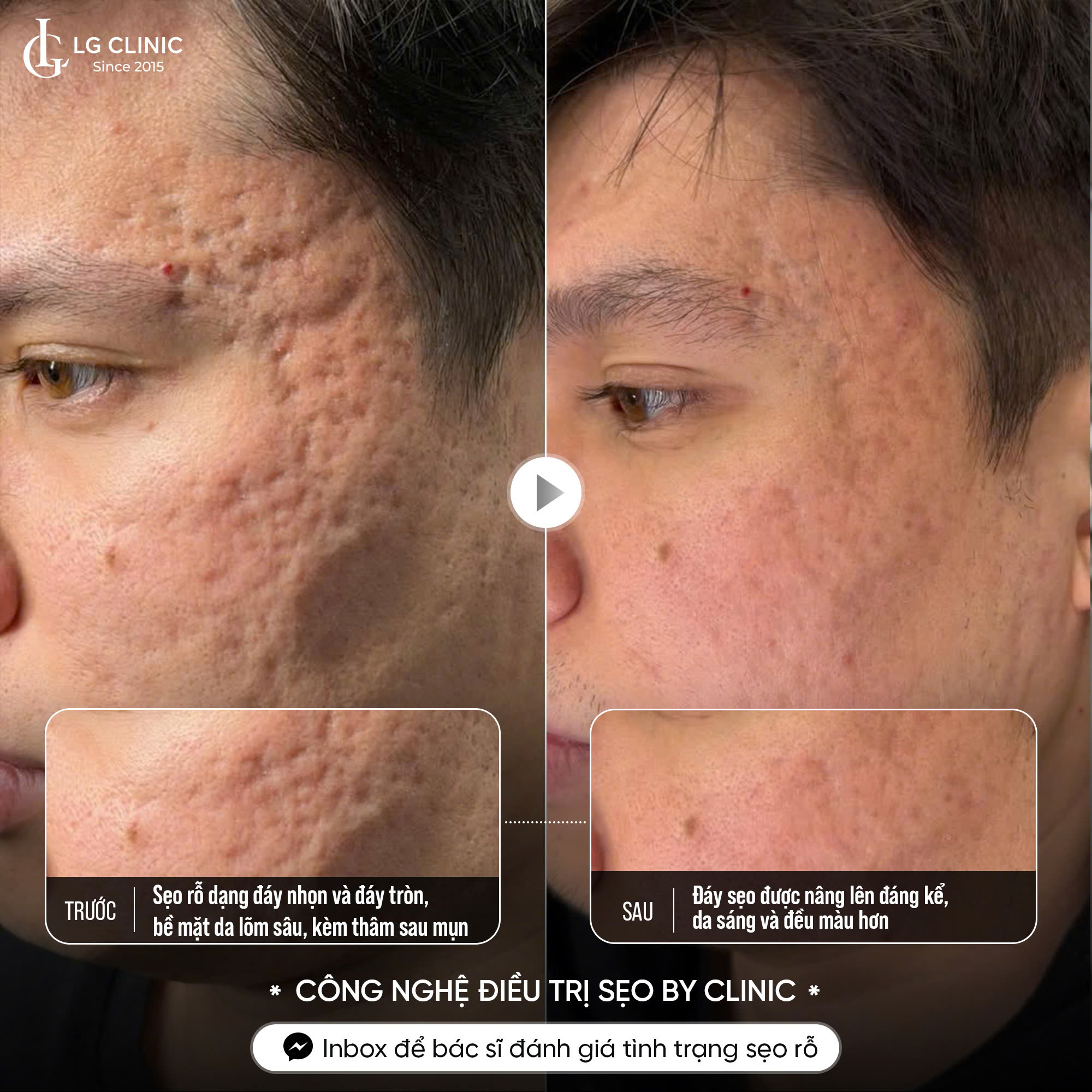 hiệu quả sau khi điều trị sẹo rỗ đáy tròn