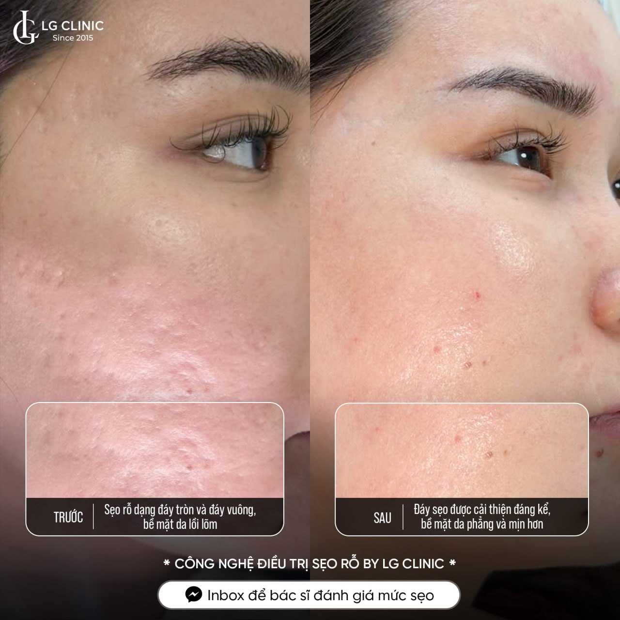 hình ảnh điều trị sẹo rỗ đáy vuông