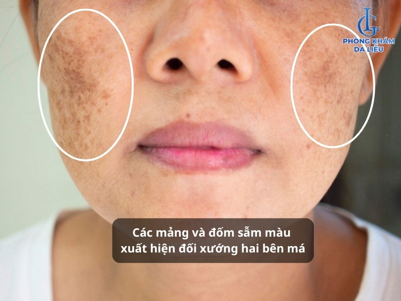 hình ảnh nám da mặt vùng má