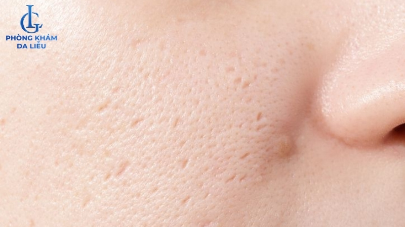 hình ảnh sẹo đáy nhọn