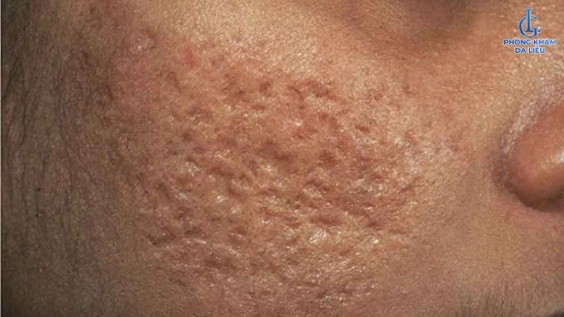 hình ảnh sẹo lõm