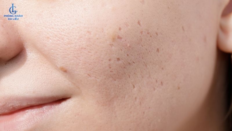 Hình ảnh sẹo rỗ đáy nhọn
