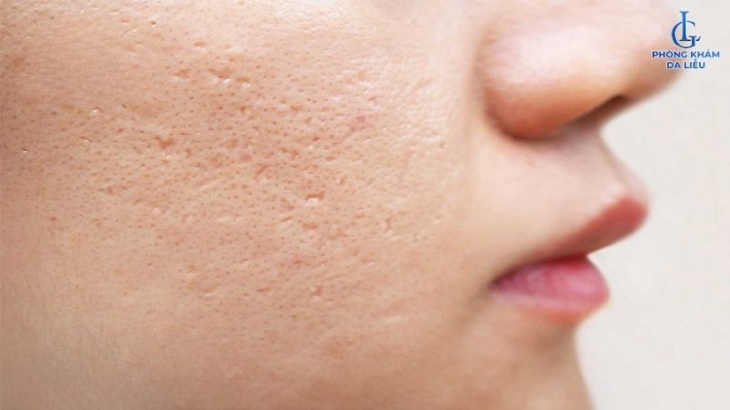 hình ảnh sẹo rỗ