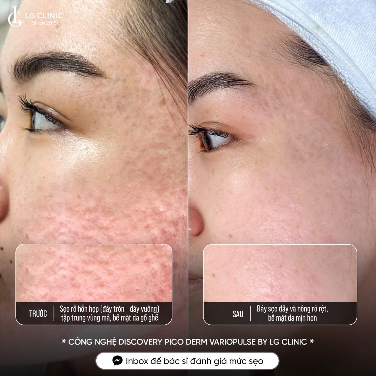 kết quả điều trị sẹo rỗ đáy vuông