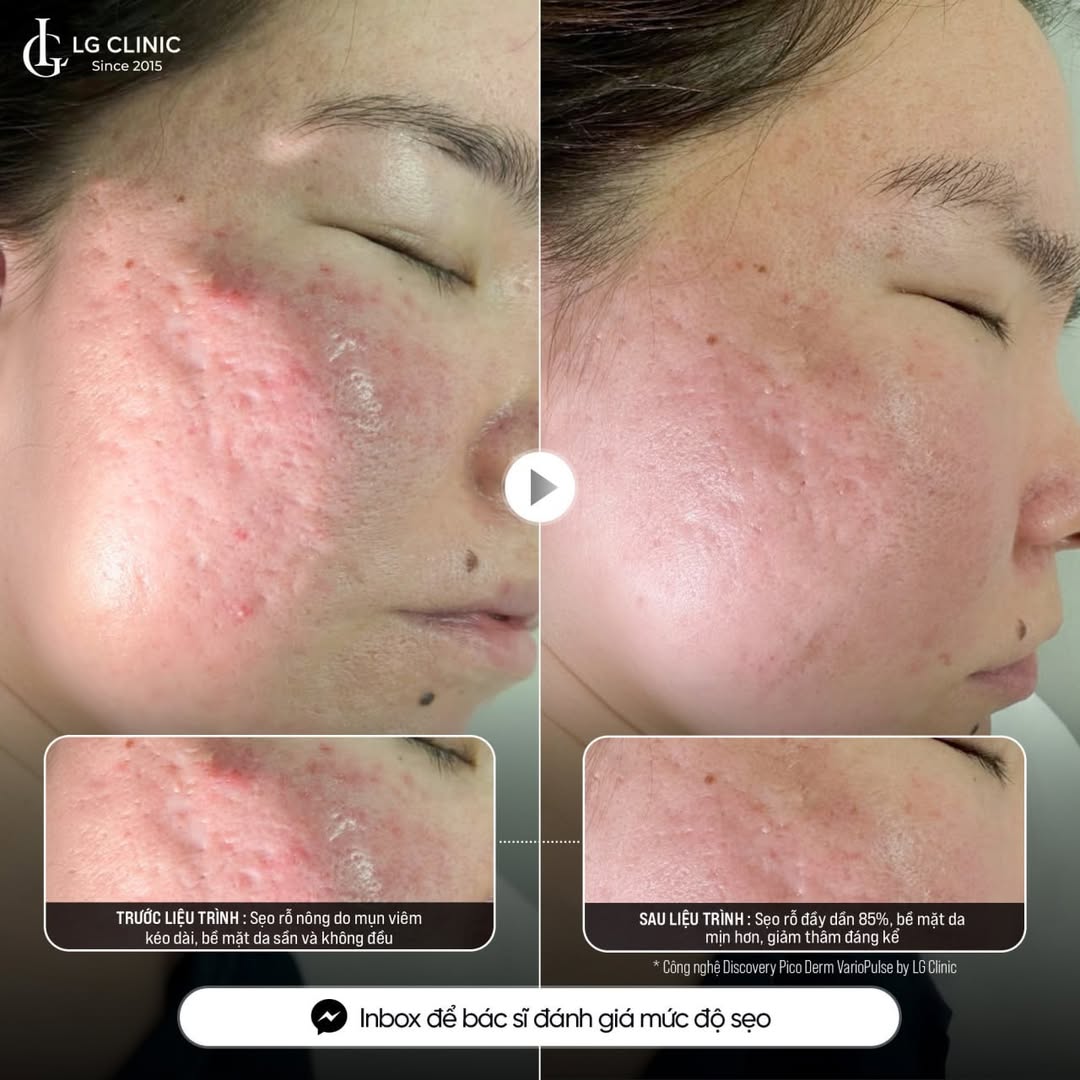 kết quả trị sẹo rỗ đáy vuông