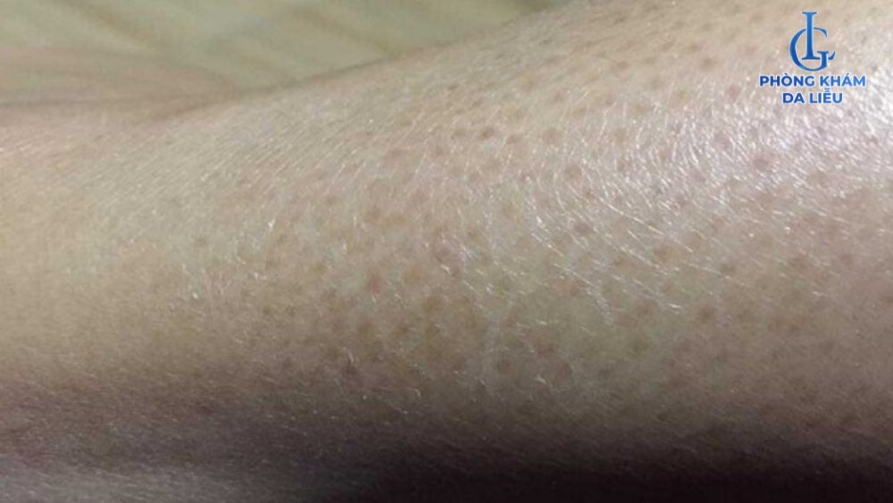 lỗ chân lông to ở chân