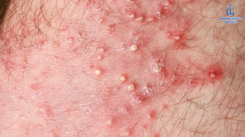 lưu ý khi điều trị viêm nang lông bằng lá trầu không tại nhà