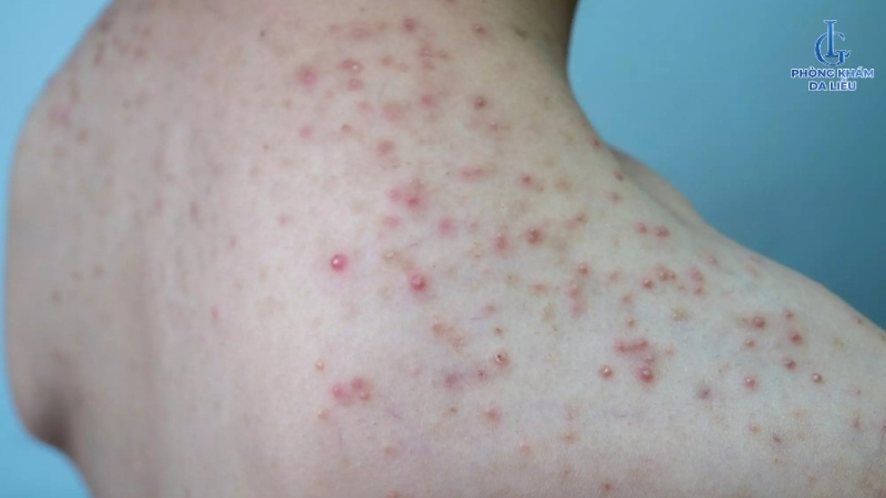 mỡ trăn trị viêm nang lông được không