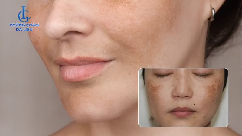 nám cánh bướm