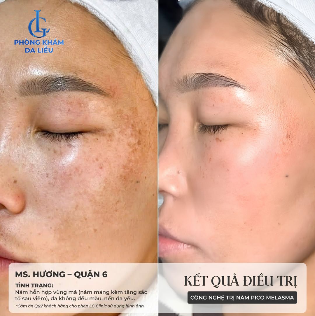 nám cánh bướm là gì