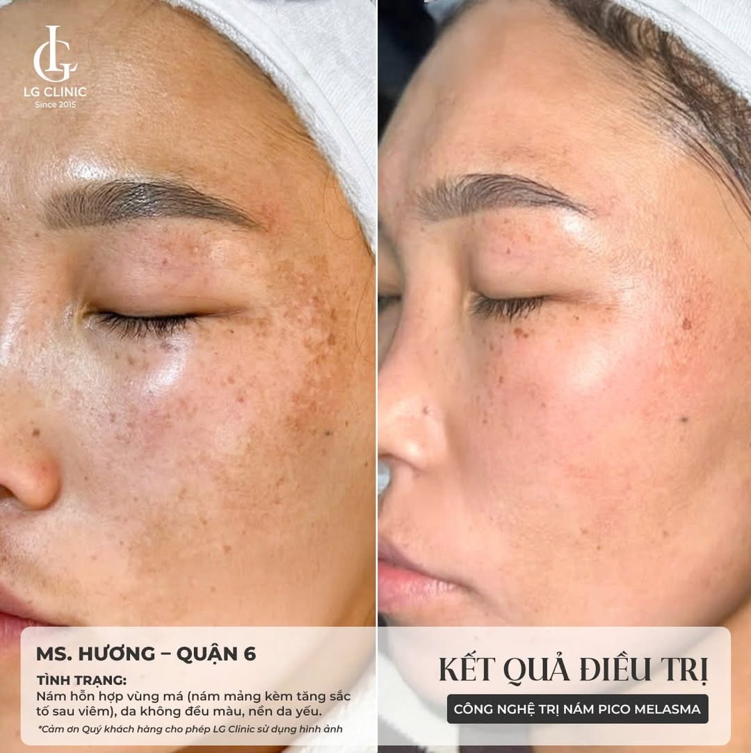 nám cánh bướm là gì