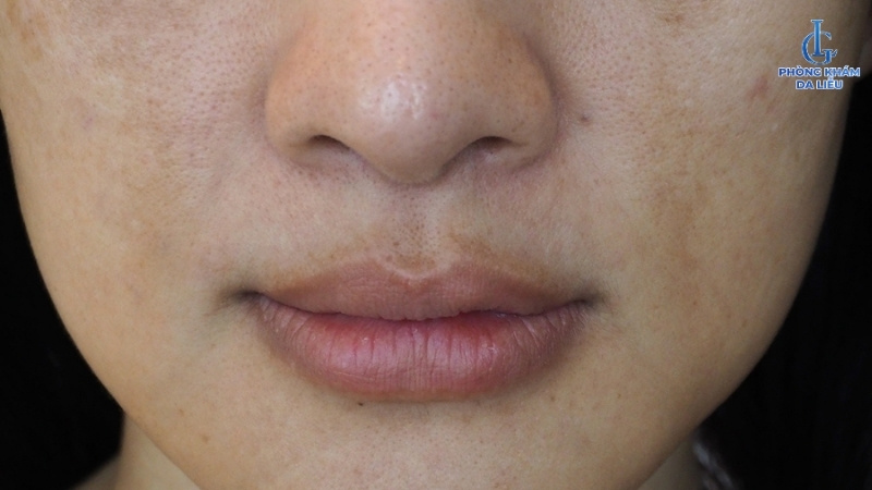 nám da quanh miệng