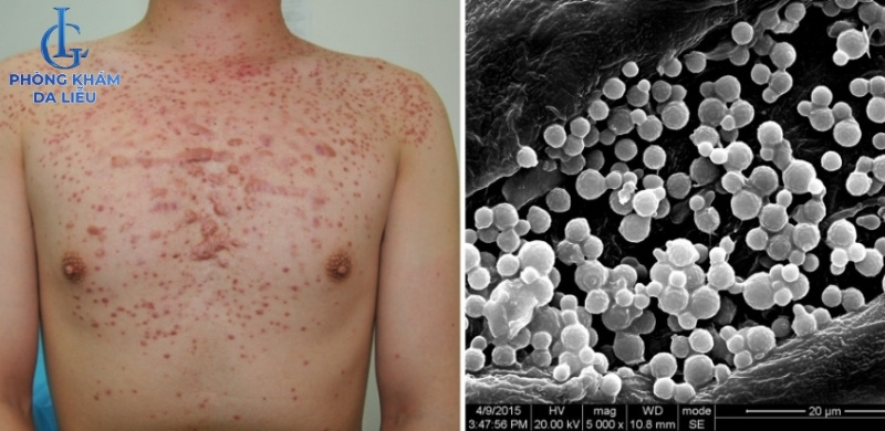 nấm gây viêm nang lông hông ban hình mạng lưới