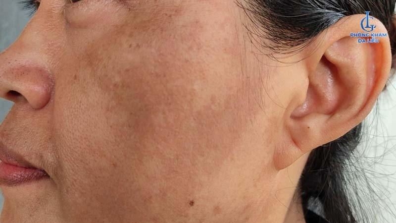 nám mảng và nám chân sâu