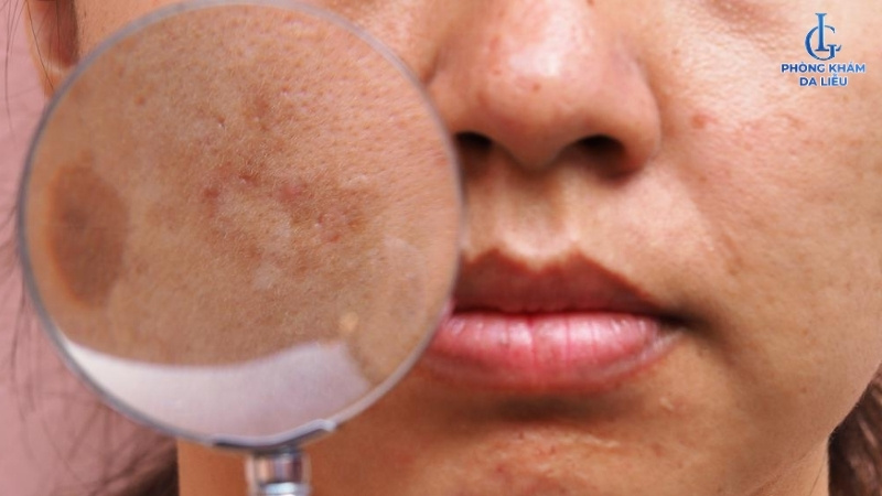 nám sau sinh có tự hết hay không