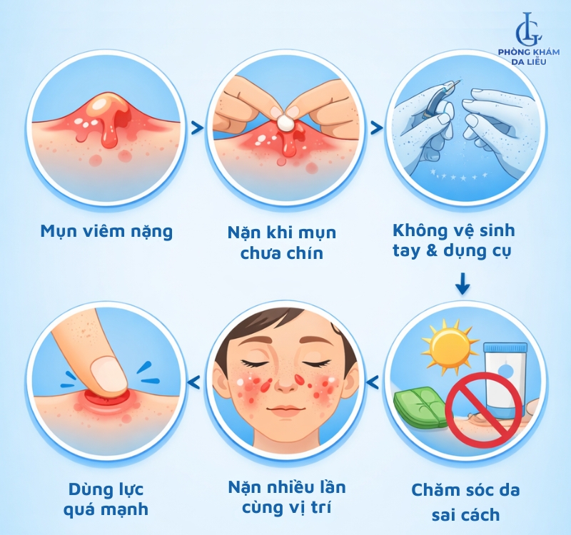 Lý do nặn mụn bị sẹo rỗ